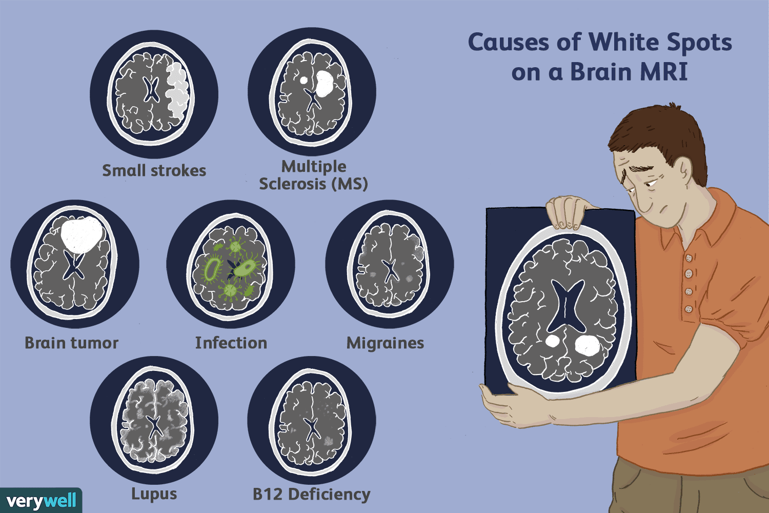 What Is Migraine And What Does Mri Of Brain Tell Us